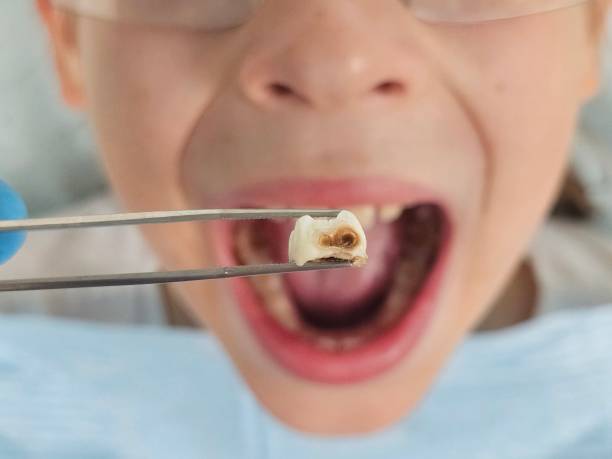 Best Emergency Dental Care for Sports Injuries in Salmon Brook, CT